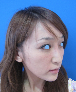 目の下のたるみ、目のくまでお悩みの方、切らずに完璧に解決します。TCB-R法　手術直後　症例写真